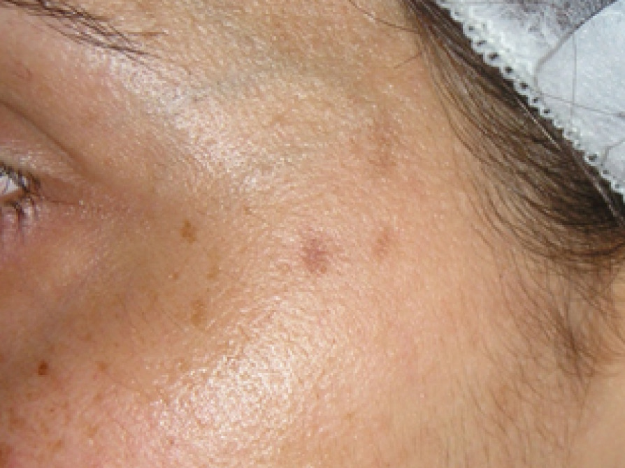 Huid voor de hydrabrasie behandeling