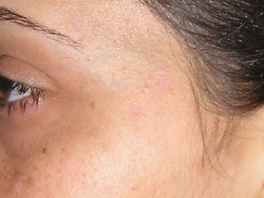 Resultaat na de LED-therapie behandeling